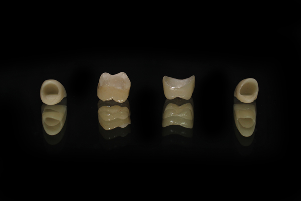 How A Porcelain Crown Can Save A Natural Tooth