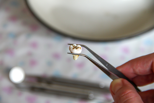 The Difference Between Simple And Surgical Tooth Extraction